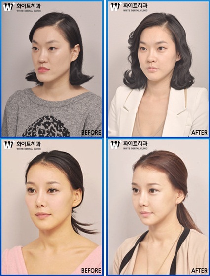 사각턱을 양악수술로 부드럽게 하려면 체크포인트 뭐뭐... - 손에 잡히는 뉴스 눈에 보이는 뉴스 - 뉴스엔