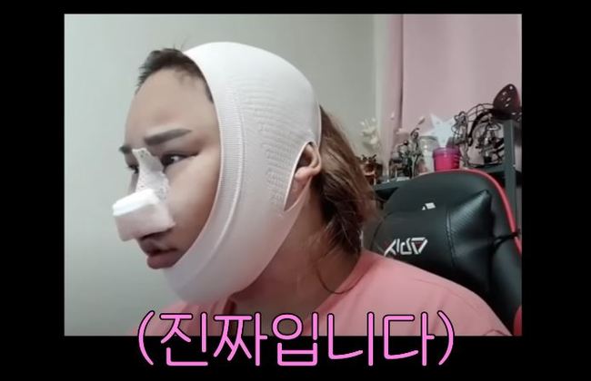풍자, 얼굴 갈아엎은 성형 당일→충격 얼굴로 “10만 스타 감사 라이브”(A급장영란) - 손에 잡히는 뉴스 눈에 보이는 뉴스 - 뉴스엔